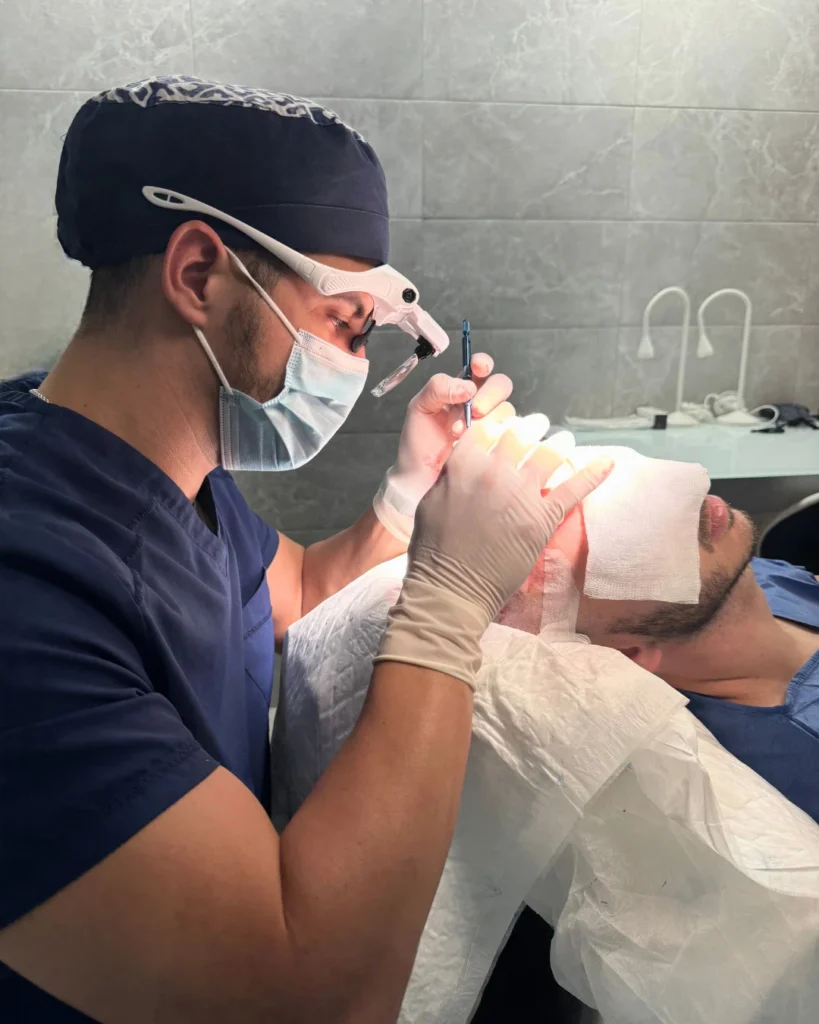 injerto capilar con técnica fue zafiro