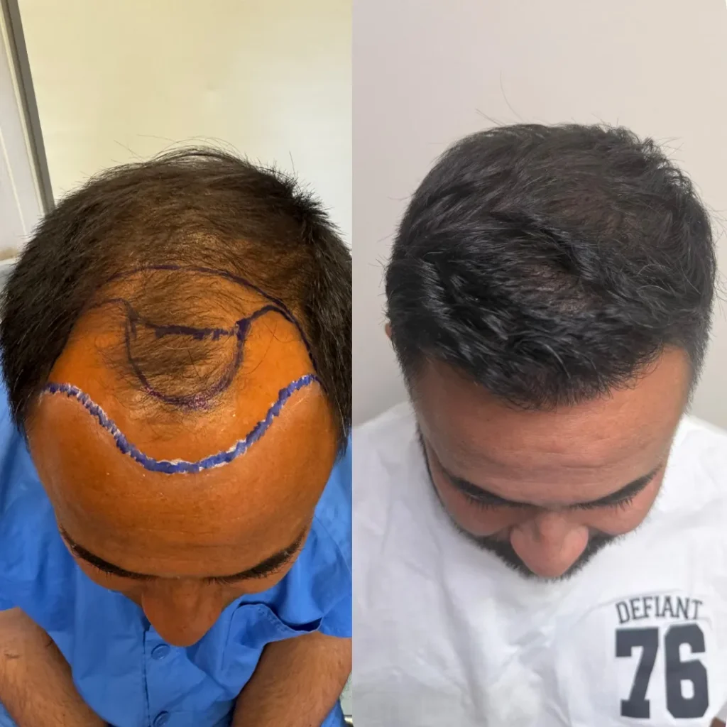 antes y después cirugía capilar 1